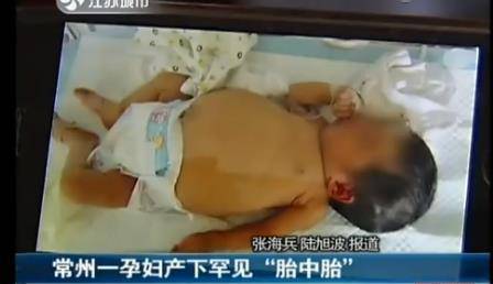 江苏常州孕妇产下胎中胎