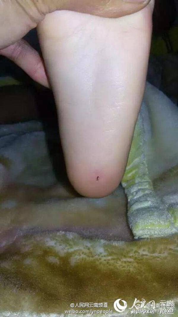 幼儿园入学第一天 云南4岁男童脚底插牙签(2)