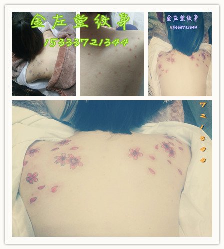 遮盖青春痘樱花纹身@＃金左堂纹身 ＃➹盖疤痕➹修改纹身