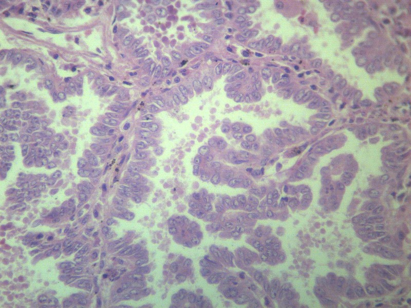 腺癌 显微切片图片(10张)