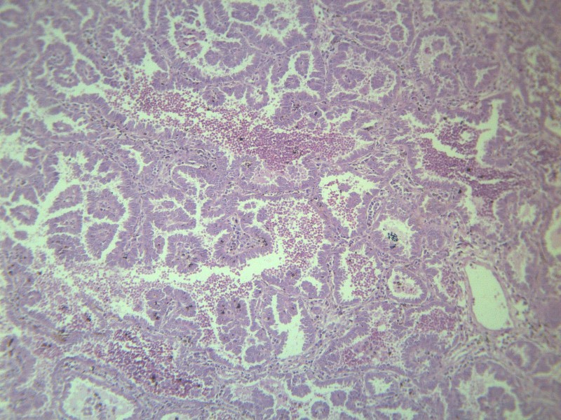 腺癌 显微切片图片(10张)