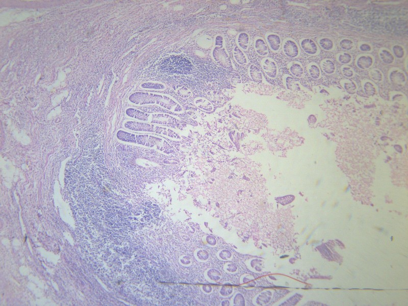 阑尾炎 显微切片图片(13张)