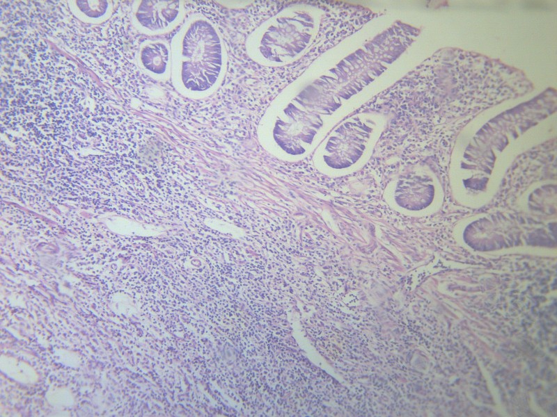 阑尾炎 显微切片图片(13张)