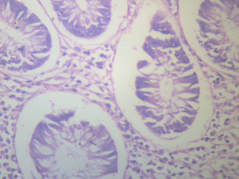阑尾炎 显微切片图片(13张)