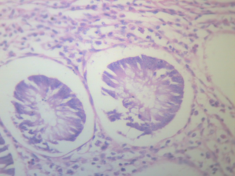 阑尾炎 显微切片图片(13张)