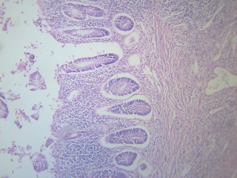 阑尾炎 显微切片图片(13张)