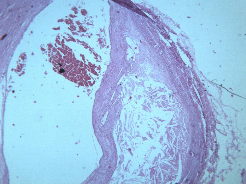 动脉粥样硬化 显微图片(13张)