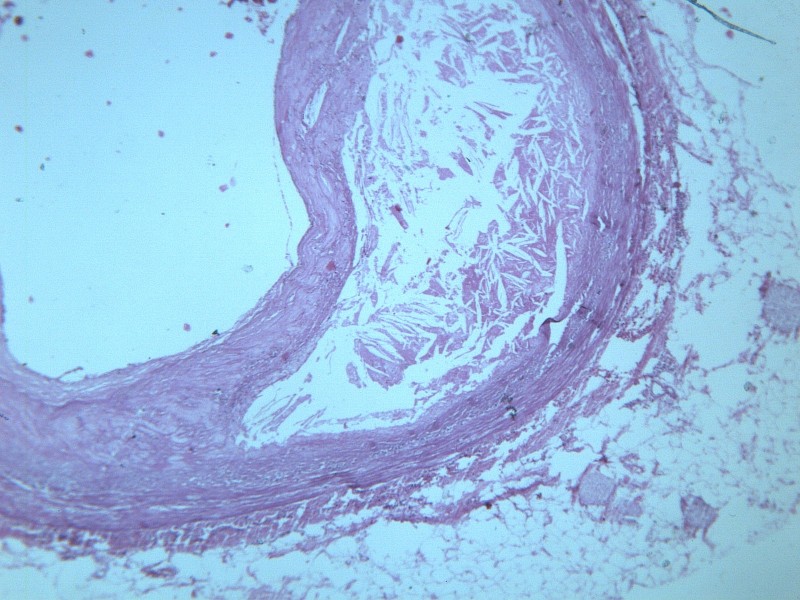 动脉粥样硬化 显微图片(13张)