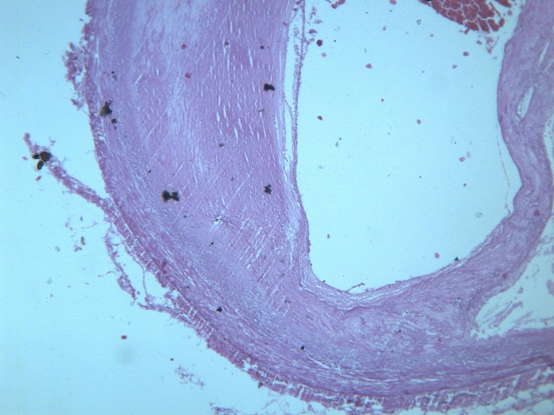 动脉粥样硬化 显微图片(13张)