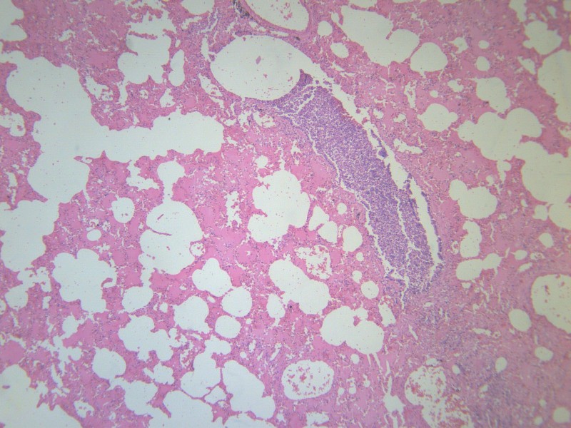 小叶性肺炎 显微图片(20张)