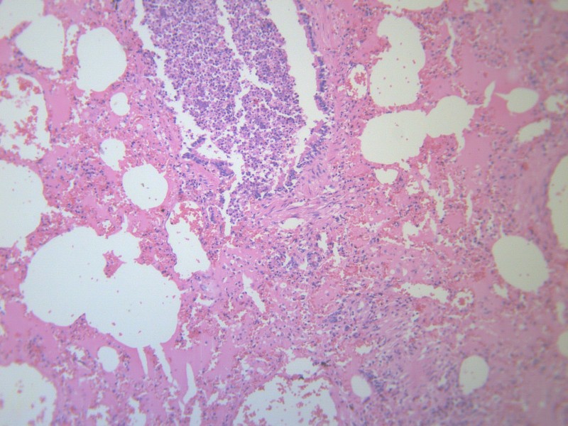 小叶性肺炎 显微图片(20张)