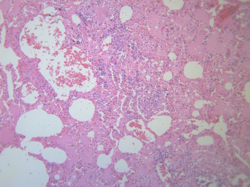小叶性肺炎 显微图片(20张)