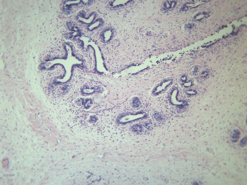 乳腺纤维腺瘤 显微切片图片(11张)