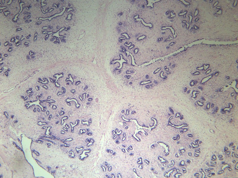 乳腺纤维腺瘤 显微切片图片(11张)