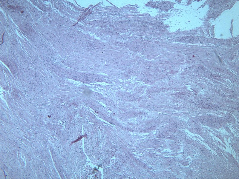 纤维瘤 显微图片(16张)