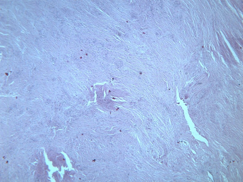 纤维瘤 显微图片(16张)