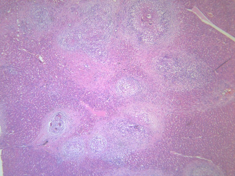 虫卵肉芽肿 显微图片(12张)