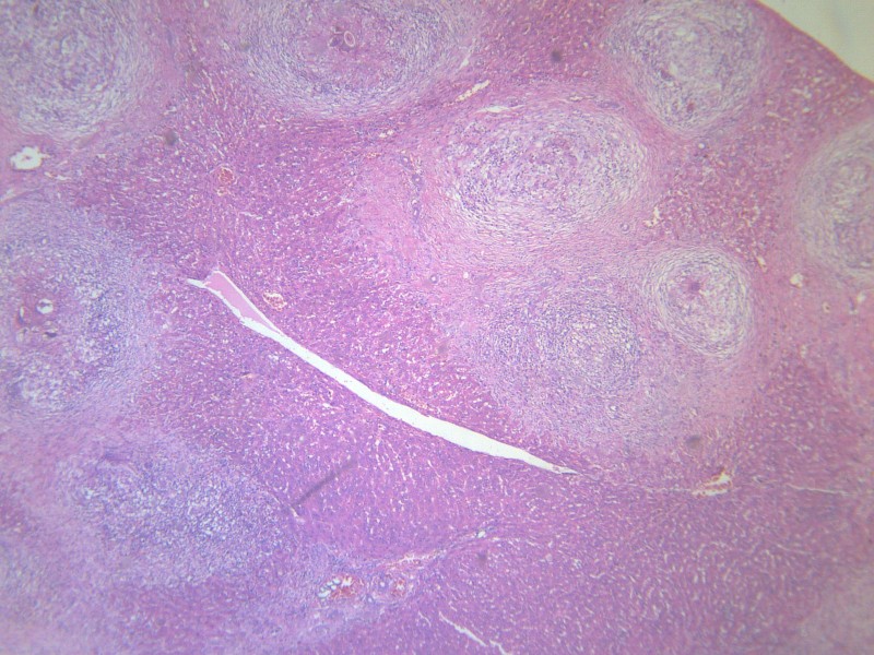 虫卵肉芽肿 显微图片(12张)