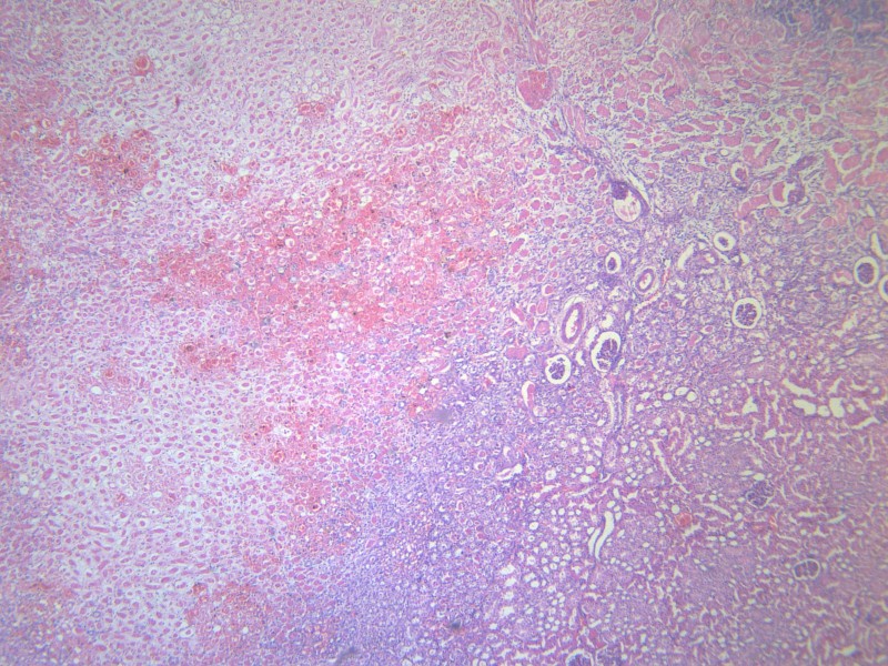 肾凝固性坏死 显微切片图片(17张)