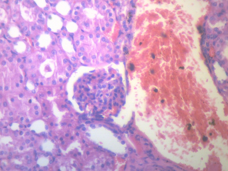 肾凝固性坏死 显微切片图片(17张)