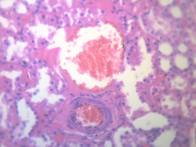肾凝固性坏死 显微切片图片(17张)