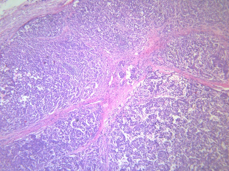 淋巴结内转移癌 显微图片(19张)