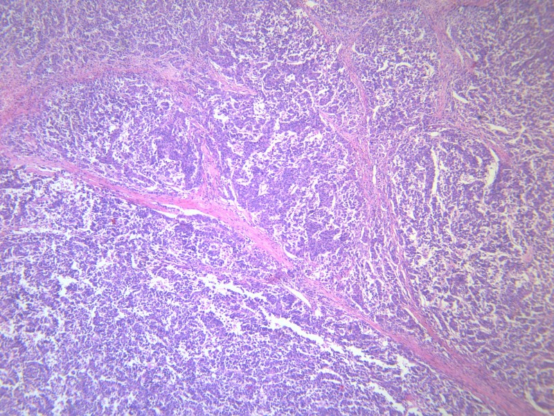 淋巴结内转移癌 显微图片(19张)