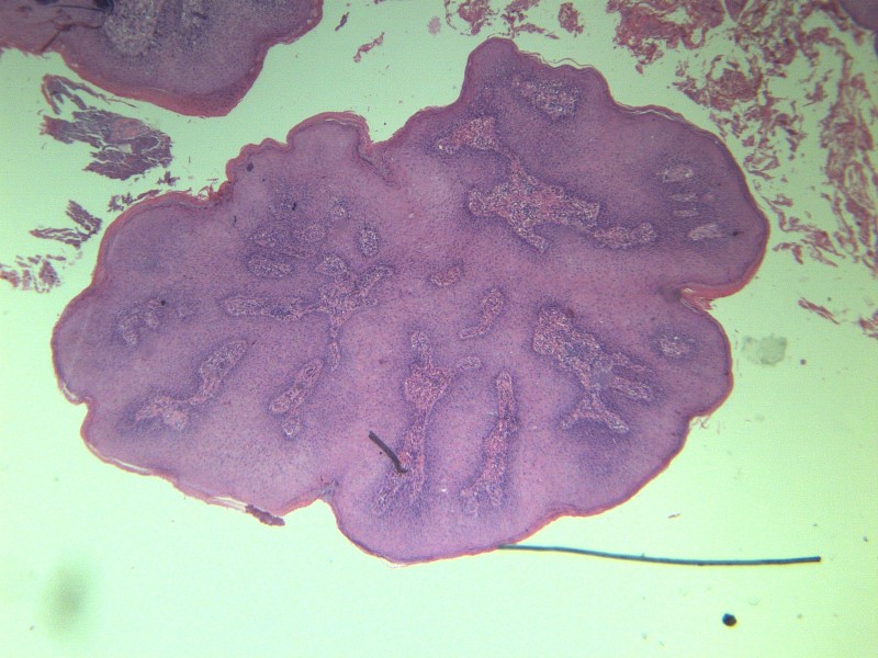 乳头状瘤 显微图片(25张)