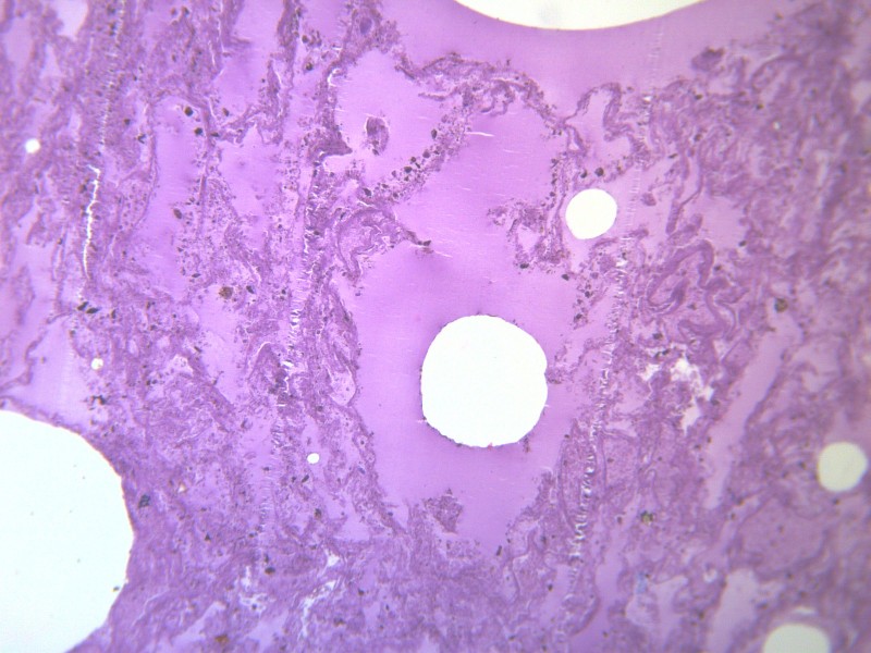 肺水肿 显微切片图片(13张)