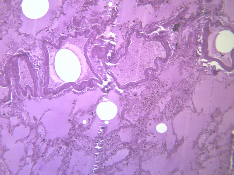 肺水肿 显微切片图片(13张)