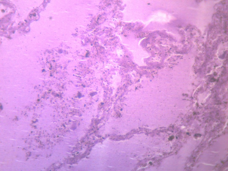 肺水肿 显微切片图片(13张)
