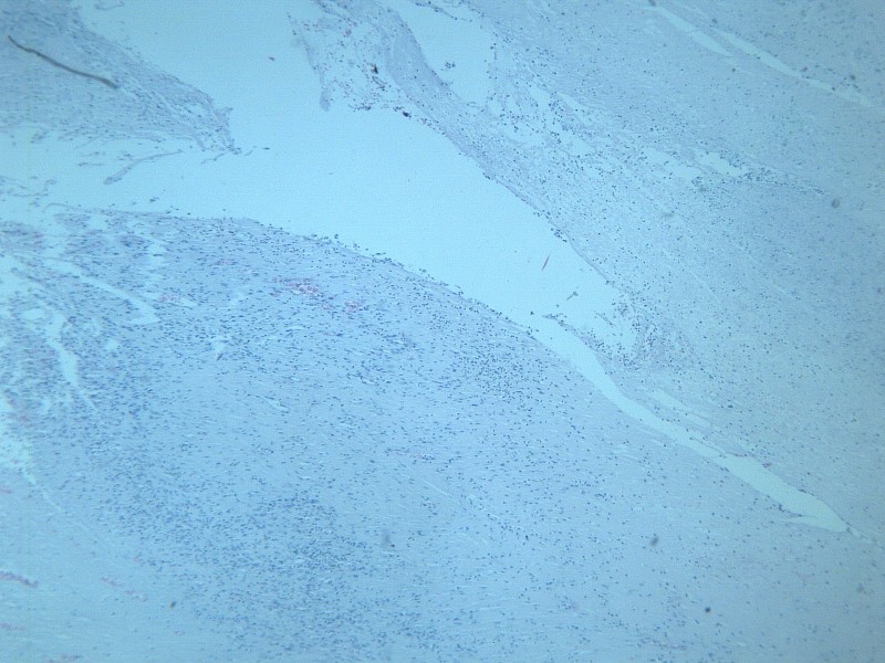 纤维肉瘤 显微切片图片(12张)