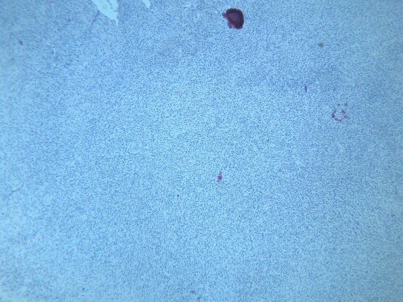 纤维肉瘤 显微切片图片(12张)