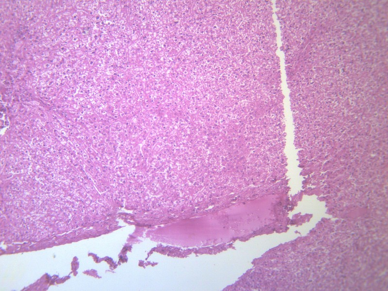 肝气球样变 显微切片图片(15张)