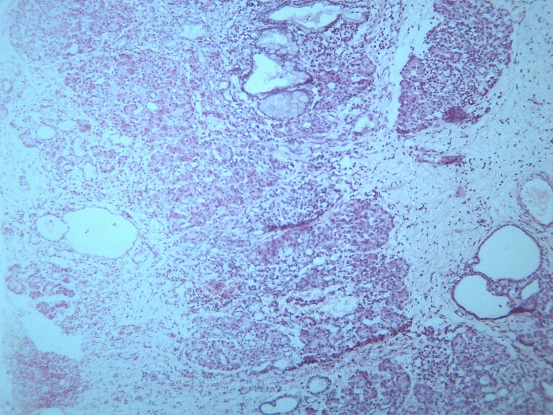 畸胎瘤 显微切片图片(15张)