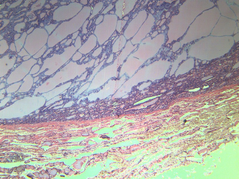 甲状腺瘤 显微切片图片(11张)