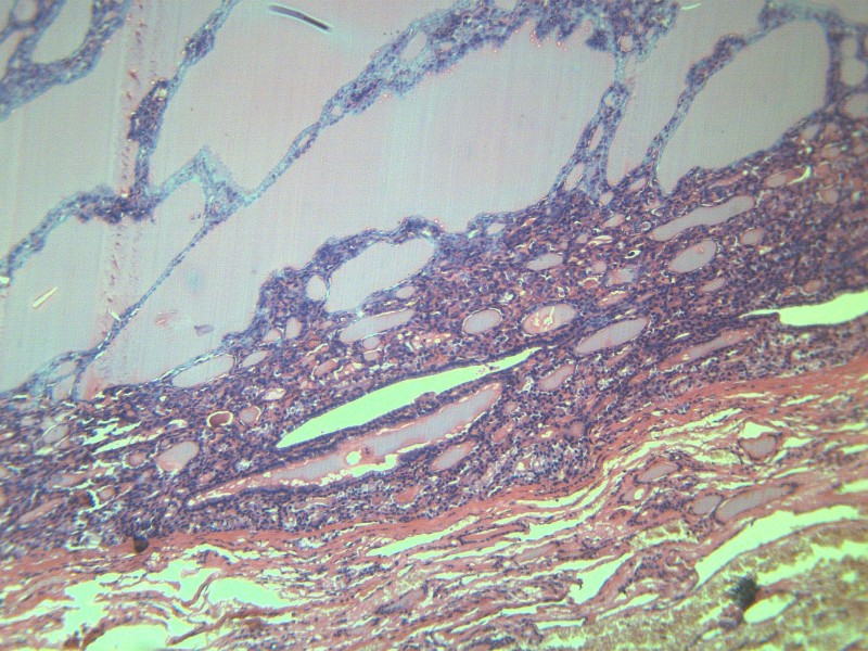 甲状腺瘤 显微切片图片(11张)