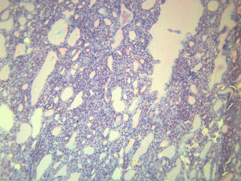 甲状腺瘤 显微切片图片(11张)