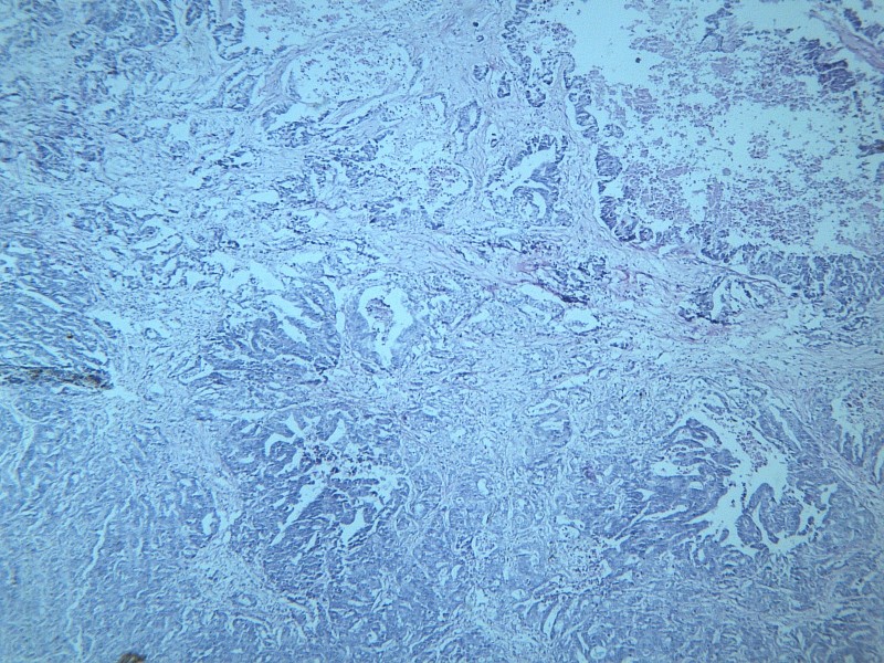 腺癌肝转移 显微图片(20张)