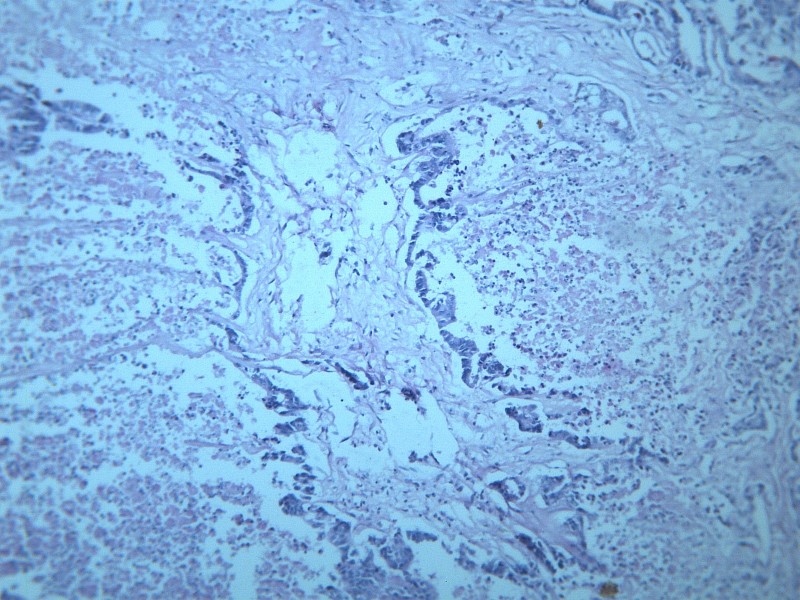 腺癌肝转移 显微图片(20张)