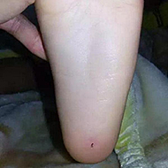 幼儿园入学第一天 云南4岁男童脚底插牙签