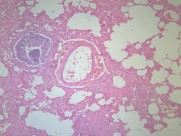 小叶性肺炎 显微图片(20张)