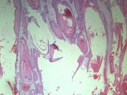 高分化鳞癌 显微切片图片(15张)