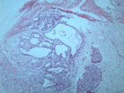 畸胎瘤 显微切片图片(15张)