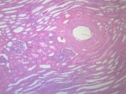 肾小管水肿 显微切片图片(11张)